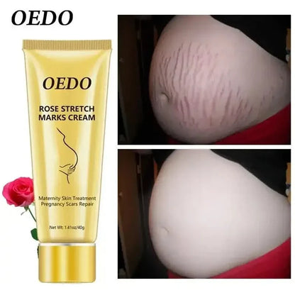 Best Stretch Mark Removal Cream for Glowing Skin