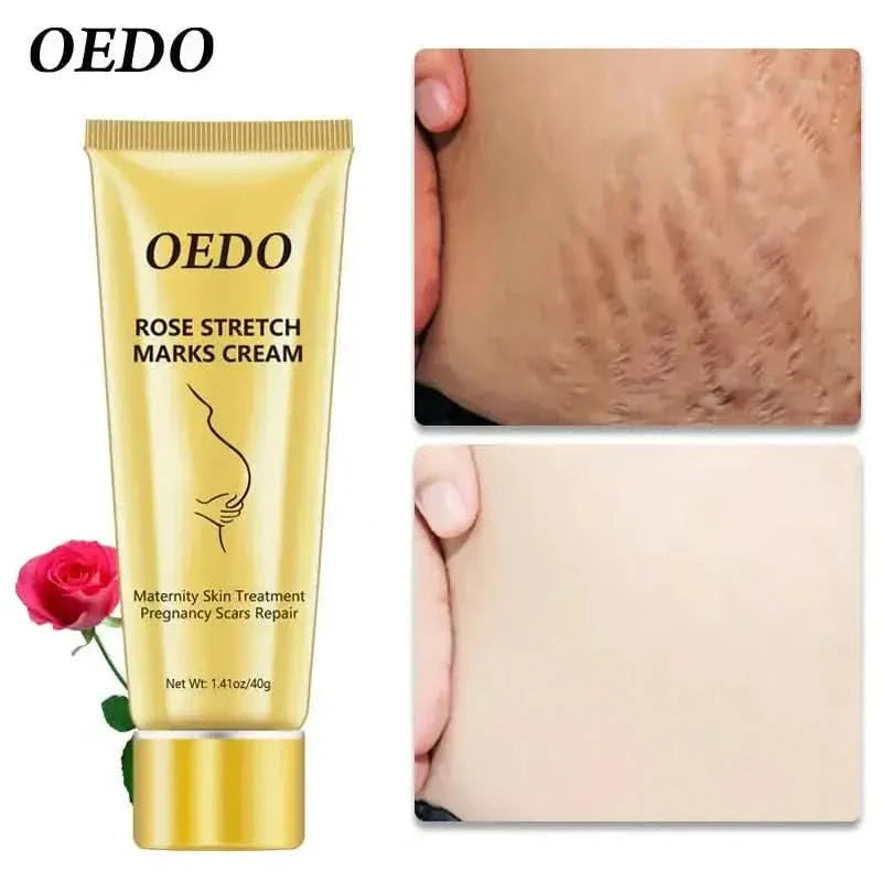 Best Stretch Mark Removal Cream for Glowing Skin