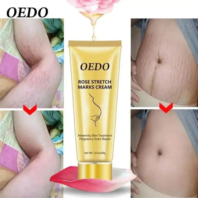Best Stretch Mark Removal Cream for Glowing Skin