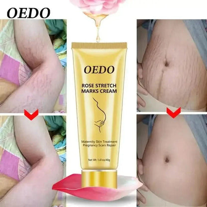 Best Stretch Mark Removal Cream for Glowing Skin