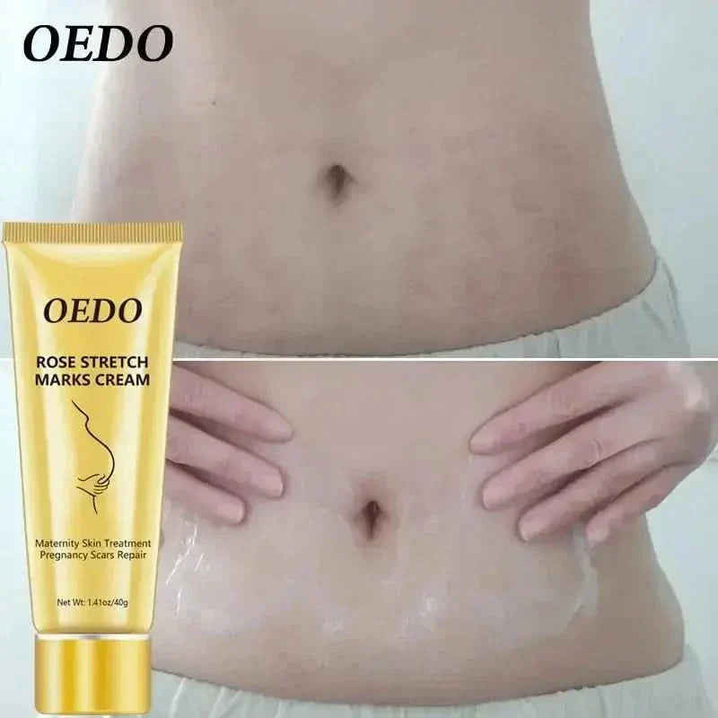 Best Stretch Mark Removal Cream for Glowing Skin