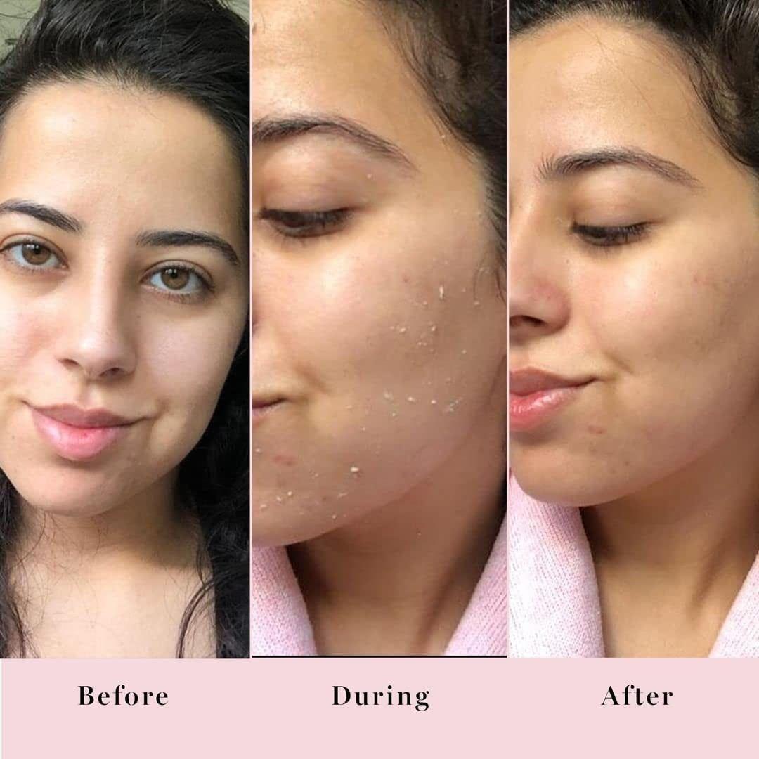Exfoliating Face Peel Gel 75ml