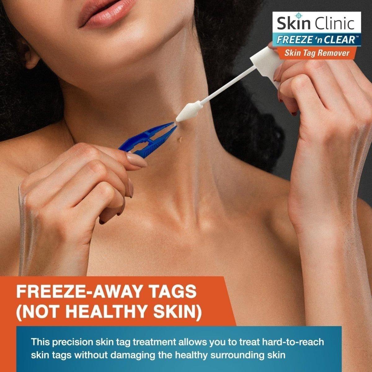 Easy Skin Tag Remover Kit with 8 Applications