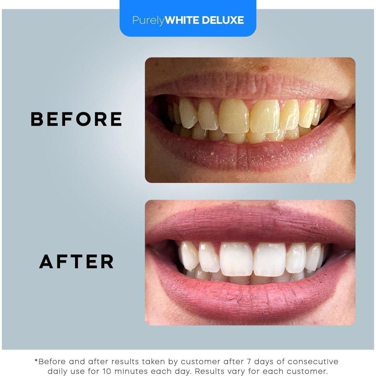 Professional At Home LED Teeth Whitening System