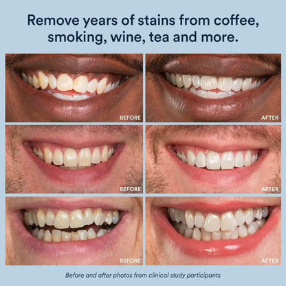 Advanced At Home Teeth Whitening System