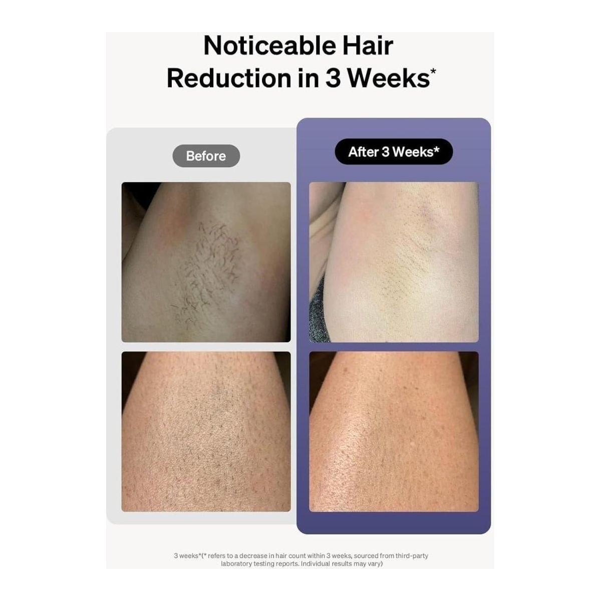 Painless At Home IPL Hair Remover with Cooling Technology
