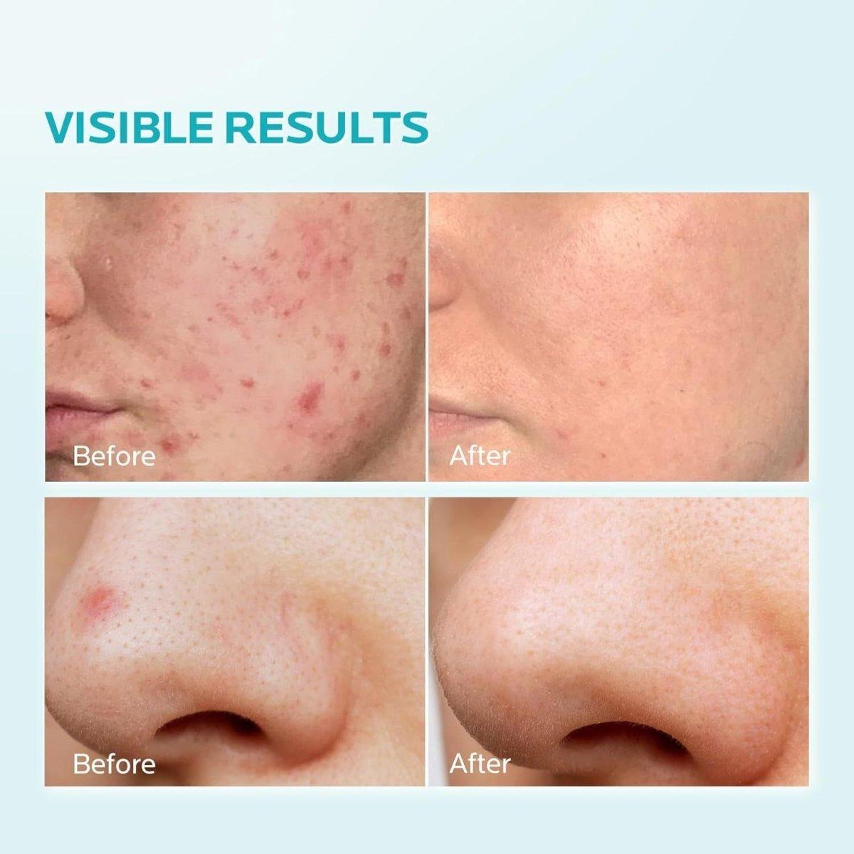 Gentle Azelaic Acid Moisturizing Cream 10% - 30ml