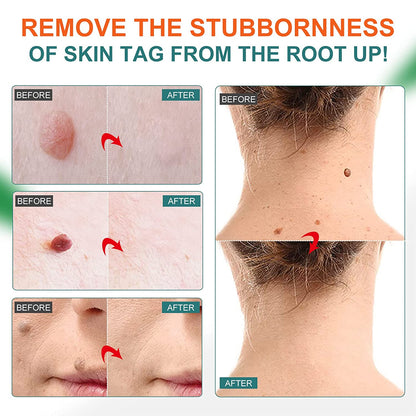 Painless Skin Tag Remover & Wart Removal Oil