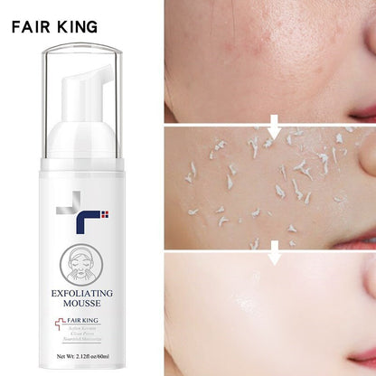 Facial Dead Skin Remover Exfoliating Peeling Gel