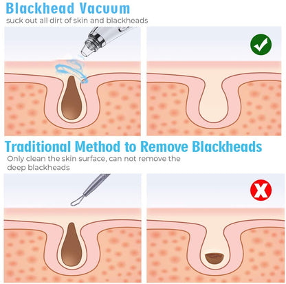 Upgraded Electric Blackhead Remover Extractor Tool
