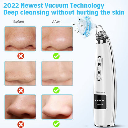 Upgraded Electric Blackhead Remover Extractor Tool